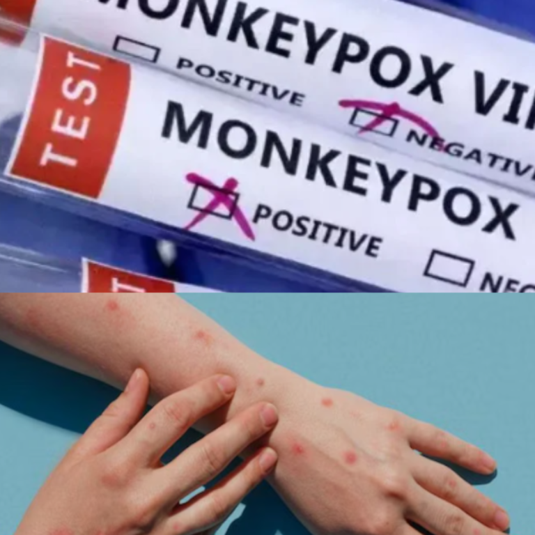Monkeypox Outbreak: What You Need to Know and How India is handling the situation