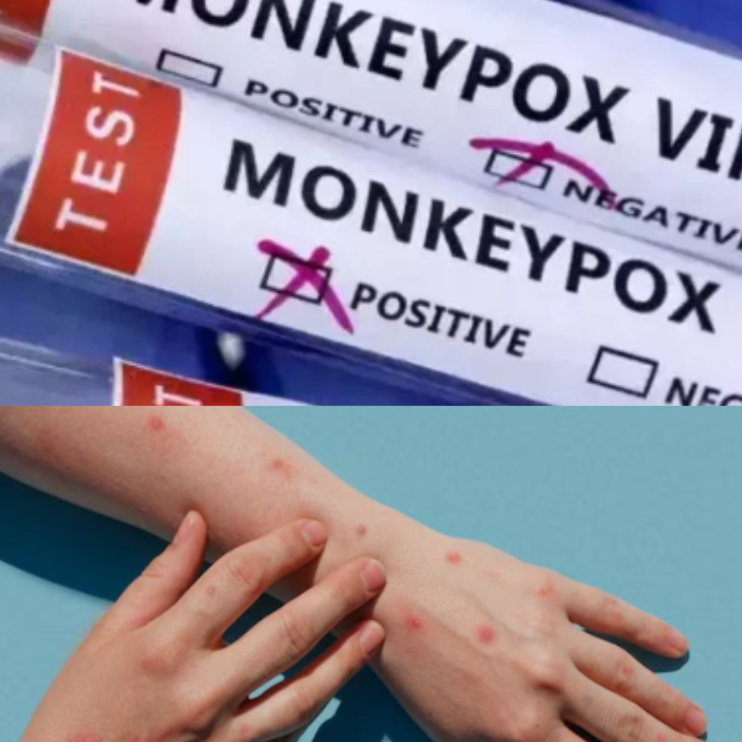 monkeypox